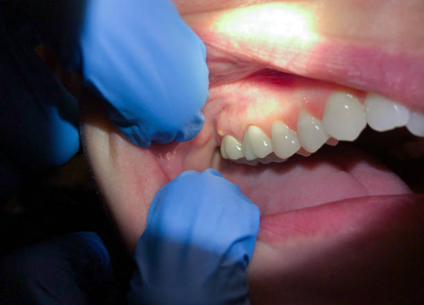 Best Urgent Tooth Repair  in Weaver, AL